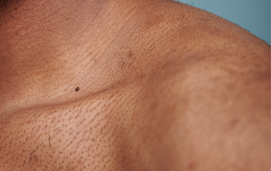 Dark Spots and Hyperpigmentation On Black Skin