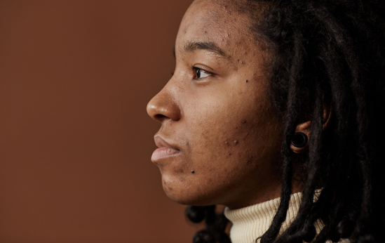 Comment prévenir et traiter l'acné sur une peau foncée ?