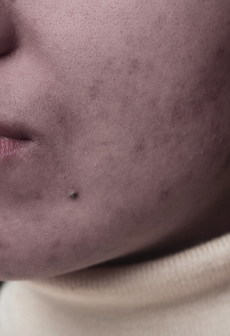 Boutons hormonaux : comment adapter sa routine skincare