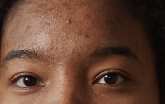 Pigmentation marks : what are they and how to make them disappear